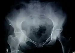 Anterior wall fracture