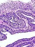Histopathology representing an inverted papilloma of the urinary bladder that was cystoscopically resected. Hematoxylin and eosion stain.