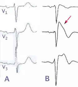 Normal electrocardiograms compared to electrocardiograms of people with Brugada Syndrome