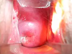Photograph of a cervix as described in caption