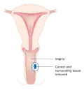 A local surgery to remove vaginal cancer