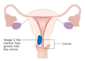 A diagram of stage II endometrial cancer