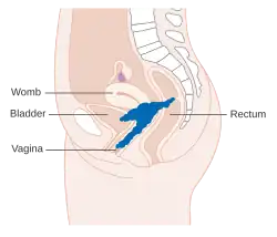 Stage 4A cervical cancer