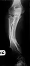 Multiple osteochondromas causing deformity of the forearm (shortening of the radius with secondary bowing of the ulna)
