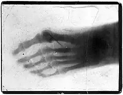 Radiograph of a pantomime artist's foot, revealing a needle by one of the toes, c. 1895