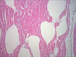 Muscle biopsy examined under the microscope (haematoxylin-eosin stain, zoom 100×): the large white areas between the muscle fibers are due to gas formation.