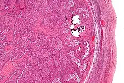 Micrograph of gonadoblastoma