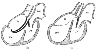 Diagrams to illustrate the transformation of the bulbus cordis. Ao. Truncus arteriosus. Au. Atrium. B. Bulbus cordis. RV. Right ventricle. LV. Left ventricle. P. Pulmonary artery.