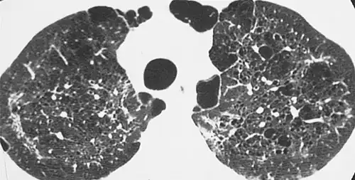 HRCT of cysts of pneumocystis pneumonia. These are usually multiple and bilateral, but range in size, shape and distribution.[7]