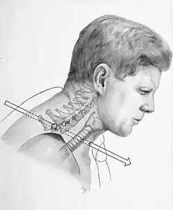 A sketch shows an arrow illustrating the first bullet that struck John F. Kennedy. The bullet is seen entering into his neck and exiting the throat