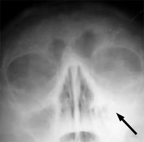 X-ray of left-sided maxillary sinusitis marked by an arrow. There is a lack of air transparency, indicating fluid in contrast to the other side.