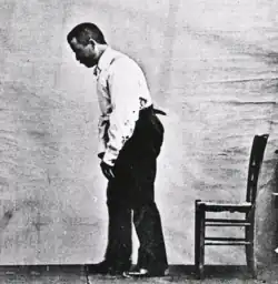 The stooped posture of a patient with Parkinson's