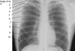 X-ray image of a human chest, with ribs labelled