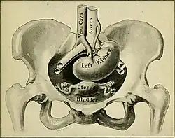 An labelled illustration showing an ectopic kidney inside an anatomically female human abdomen